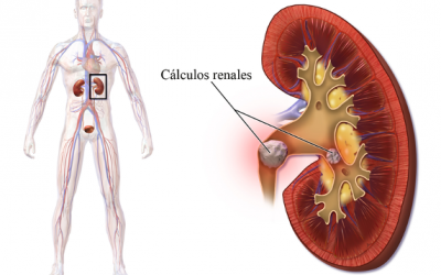 Avances en la lucha contra los cálculos urinarios