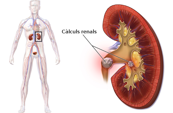 Avenços en la lluita contra els càlculs urinaris