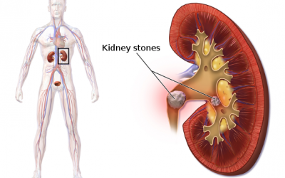 Advances in the fight against urinary calculi
