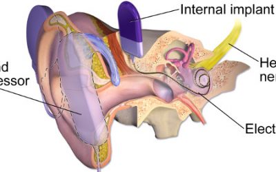 The bionic ear is already a reality