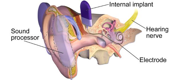 El oído biónico ya es una realidad