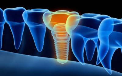 Smart dental implants