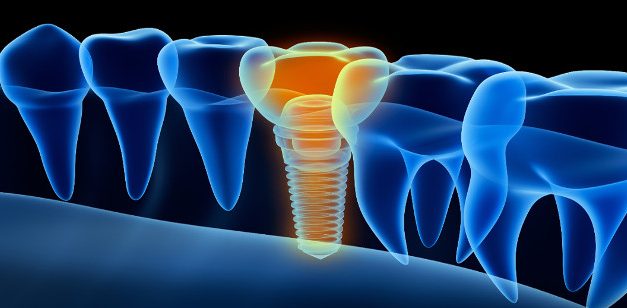 Implantes dentales inteligentes