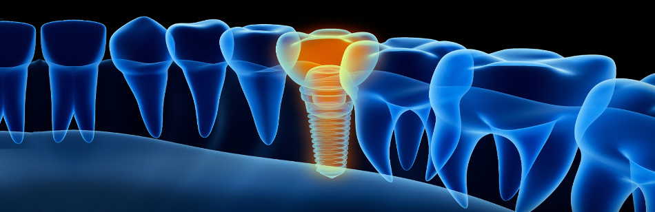 Implantes dentales inteligentes