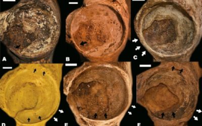 Determining skeletal age