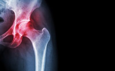 Causa comuna contra el reuma