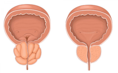 Un sistema no invasiu per intervenir la pròstata