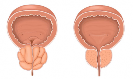 Un sistema no invasivo para intervenir la próstata