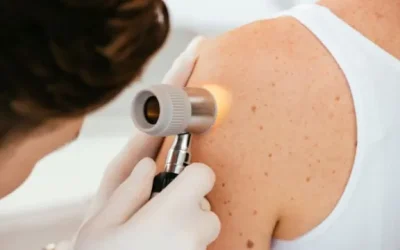 Diagnosticar y combatir con eficacia el melanoma