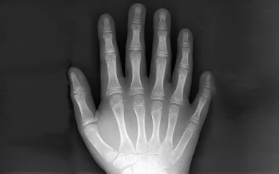 Polidactilia, la peculiaridad de tener seis dedos